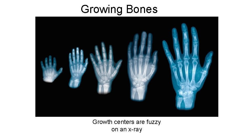 Growing Bones Growth centers are fuzzy on an x-ray Growing Bones Growth centers are fuzzy on an x-ray