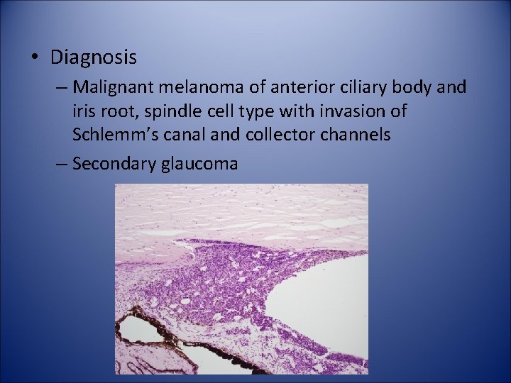  • Diagnosis – Malignant melanoma of anterior ciliary body and iris root, spindle