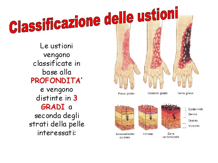 Le ustioni vengono classificate in base alla PROFONDITA’ e vengono distinte in 3 GRADI