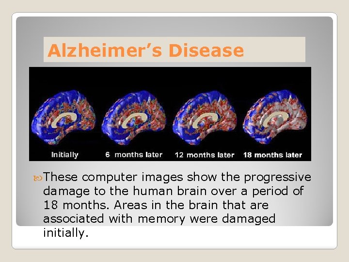 Alzheimer’s Disease These computer images show the progressive damage to the human brain over