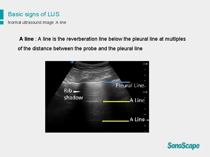Basic signs of LUS Normal ultrasound image : A line is the reverberation line