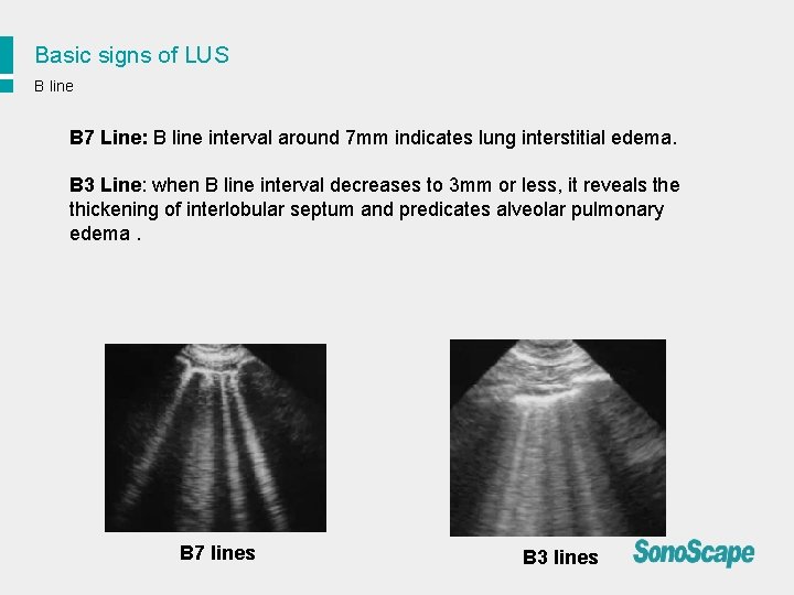 Basic signs of LUS B line B 7 Line: B line interval around 7