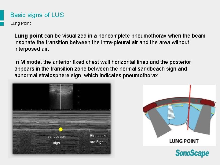 Basic signs of LUS Lung Point Lung point can be visualized in a noncomplete