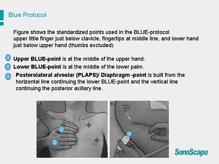 Blue Protocol Figure shows the standardized points used in the BLUE-protocol upper little finger