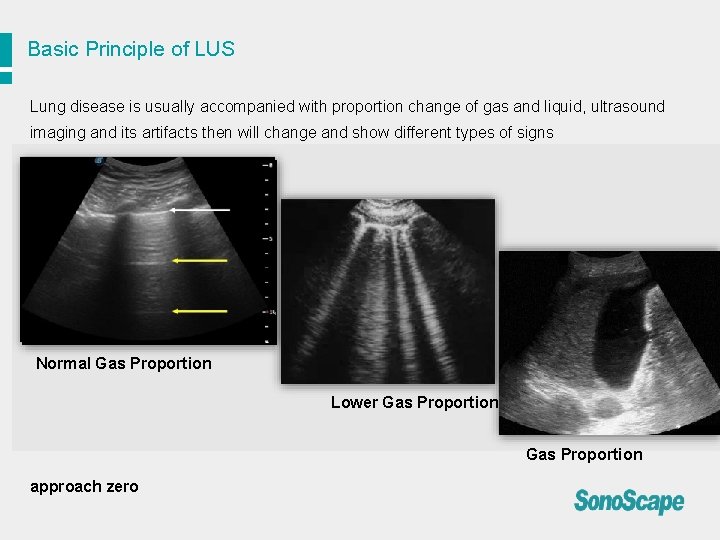 Basic Principle of LUS Lung disease is usually accompanied with proportion change of gas