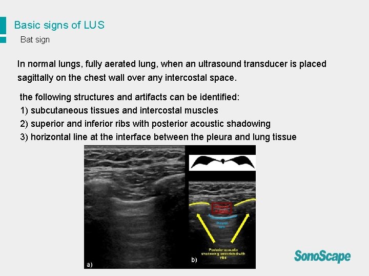 Basic signs of LUS Bat sign In normal lungs, fully aerated lung, when an