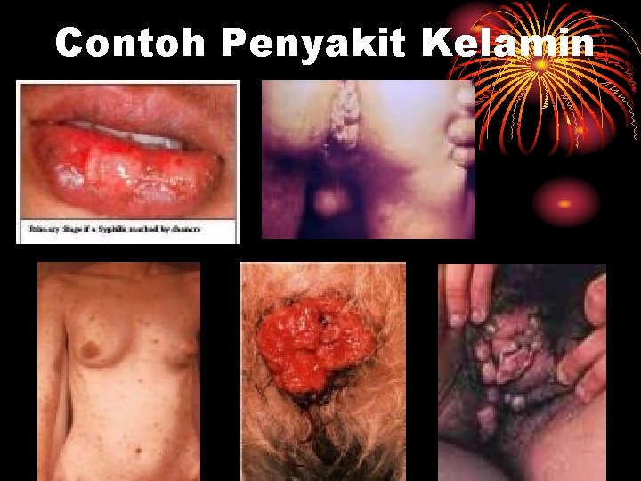 Contoh Penyakit Kelamin 