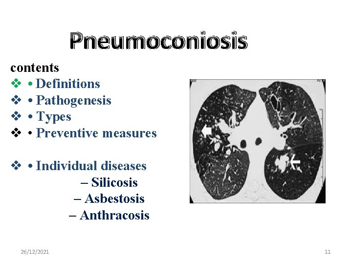 Pneumoconiosis contents v • Definitions v • Pathogenesis v • Types v • Preventive