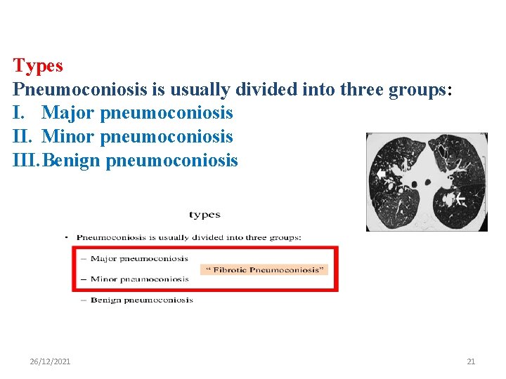 Types Pneumoconiosis is usually divided into three groups: I. Major pneumoconiosis II. Minor pneumoconiosis