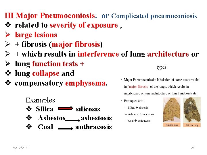 III Major Pneumoconiosis: or Complicated pneumoconiosis v related to severity of exposure , Ø