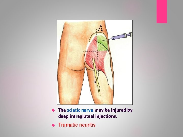  The sciatic nerve may be injured by deep intragluteal injections. Trumatic neuritis 