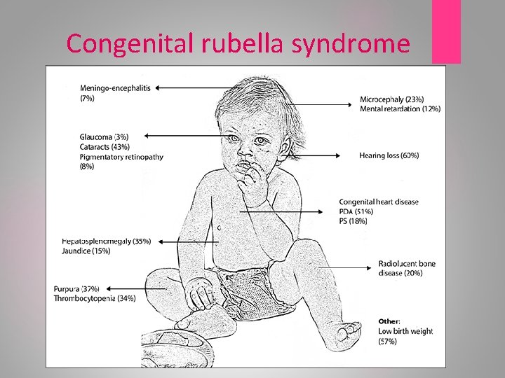 Congenital rubella syndrome 