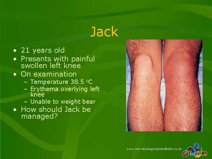 Jack • 21 years old • Presents with painful swollen left knee • On