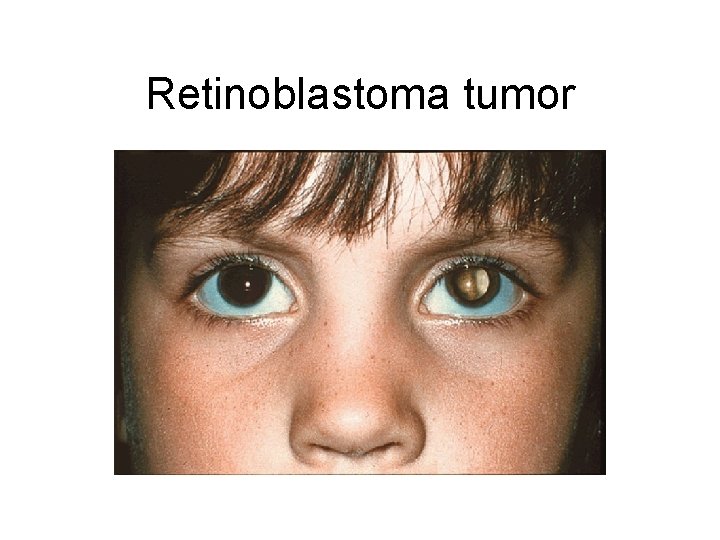 Retinoblastoma tumor 