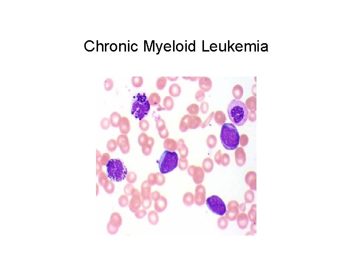 Chronic Myeloid Leukemia 