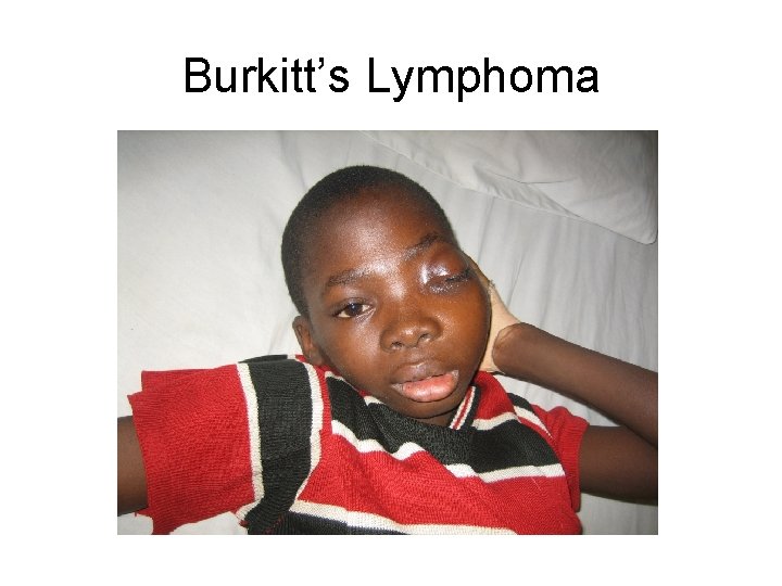 Burkitt’s Lymphoma 