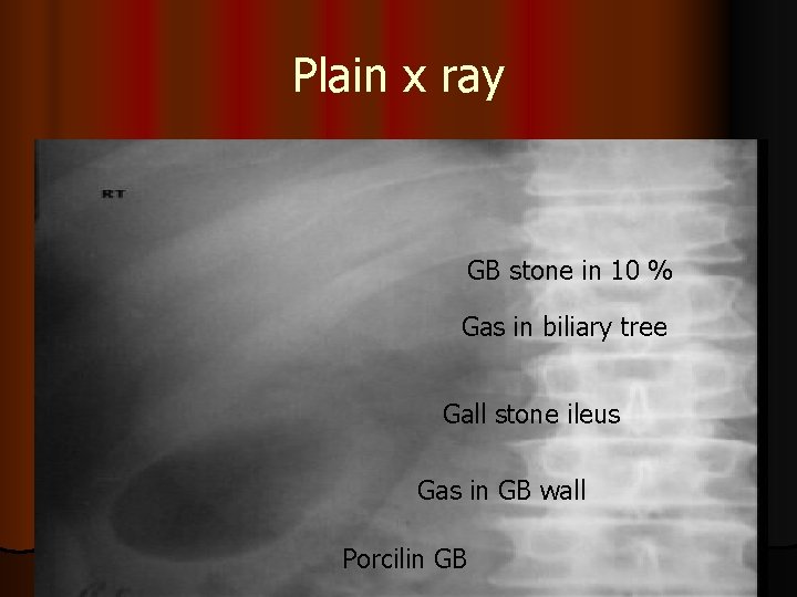 Plain x ray GB stone in 10 % Gas in biliary tree Gall stone