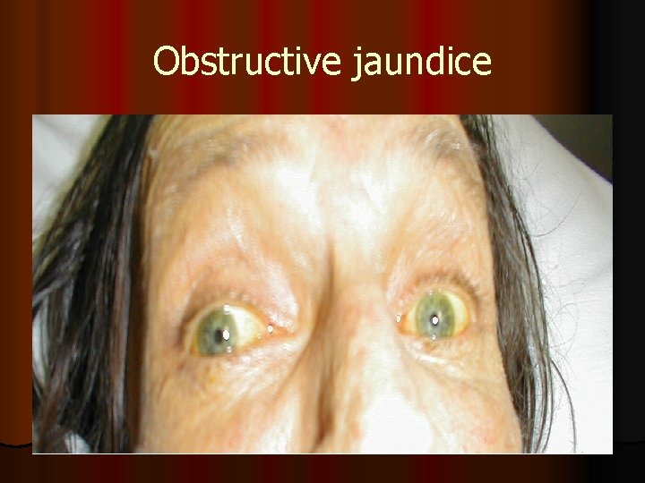 Obstructive jaundice 