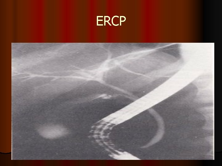 ERCP 