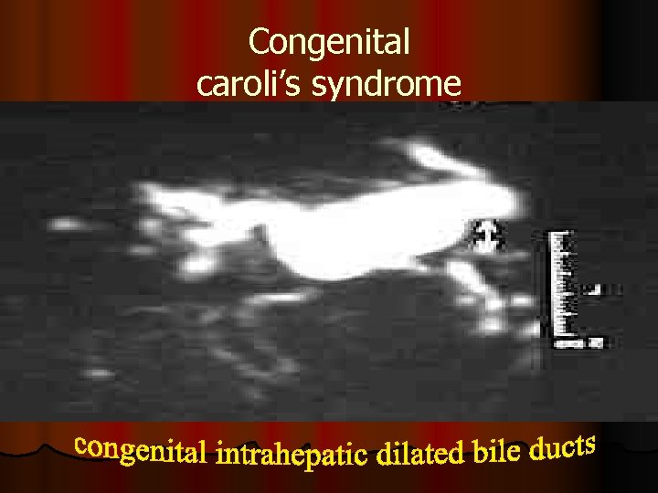 Congenital caroli’s syndrome 