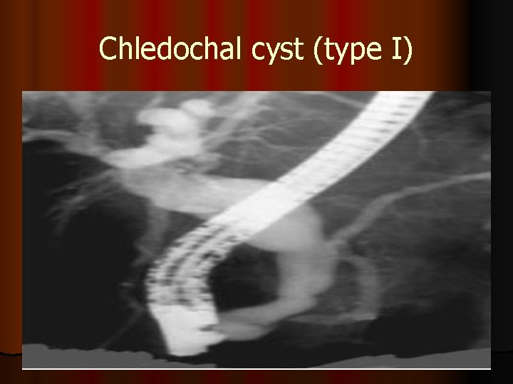 Chledochal cyst (type I) 