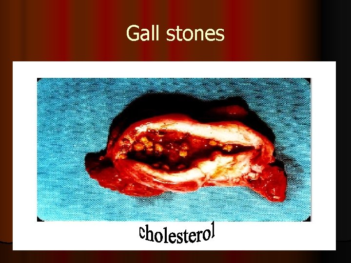 Gall stones 