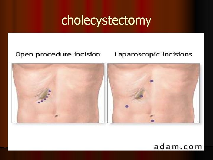 cholecystectomy 