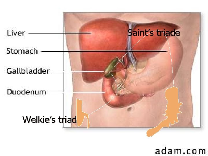 Saint’s triade Welkie’s triade 