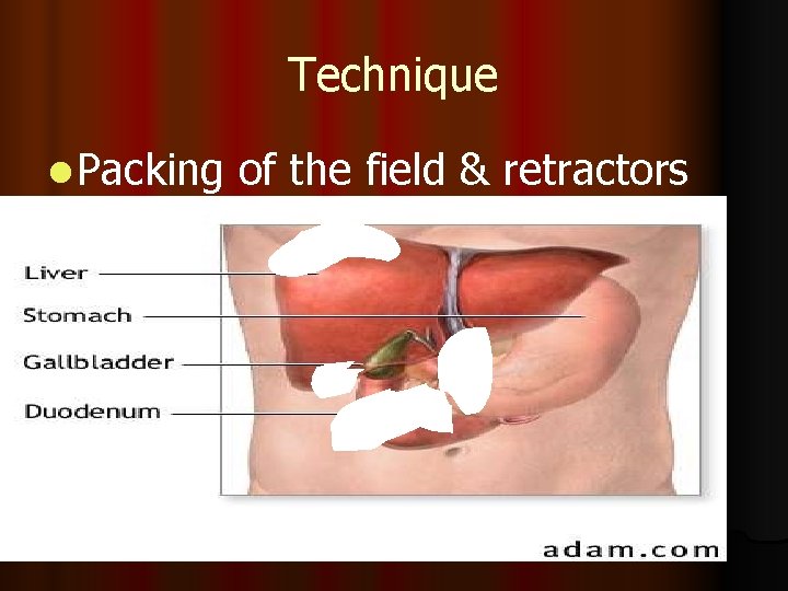 Technique l Packing of the field & retractors 