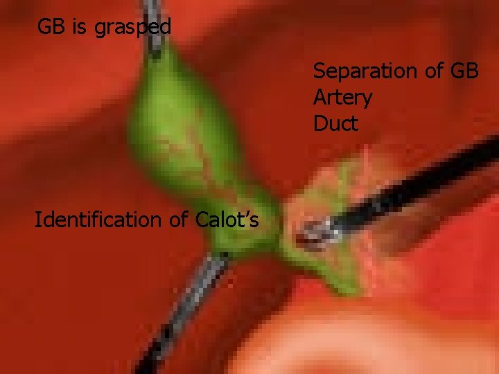 GB is grasped Separation of GB Artery Duct Identification of Calot’s 