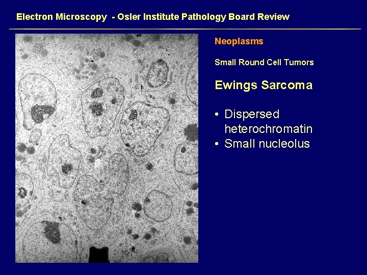 Electron Microscopy - Osler Institute Pathology Board Review Neoplasms Small Round Cell Tumors Ewings