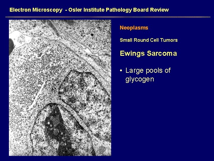 Electron Microscopy - Osler Institute Pathology Board Review Neoplasms Small Round Cell Tumors Ewings