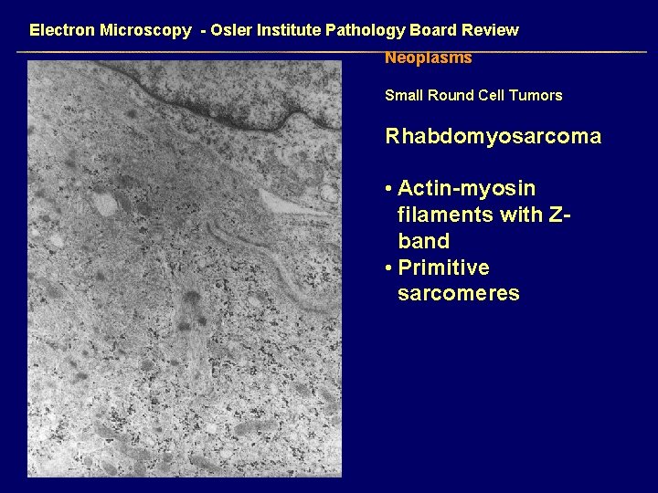 Electron Microscopy - Osler Institute Pathology Board Review Neoplasms Small Round Cell Tumors Rhabdomyosarcoma