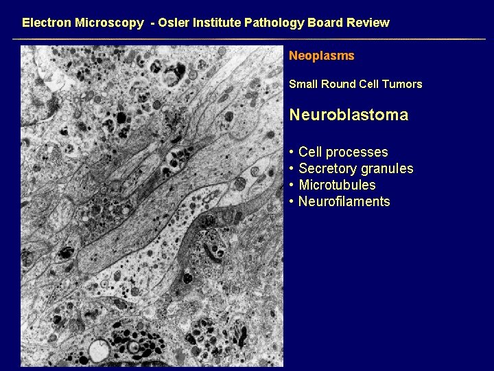 Electron Microscopy - Osler Institute Pathology Board Review Neoplasms Small Round Cell Tumors Neuroblastoma