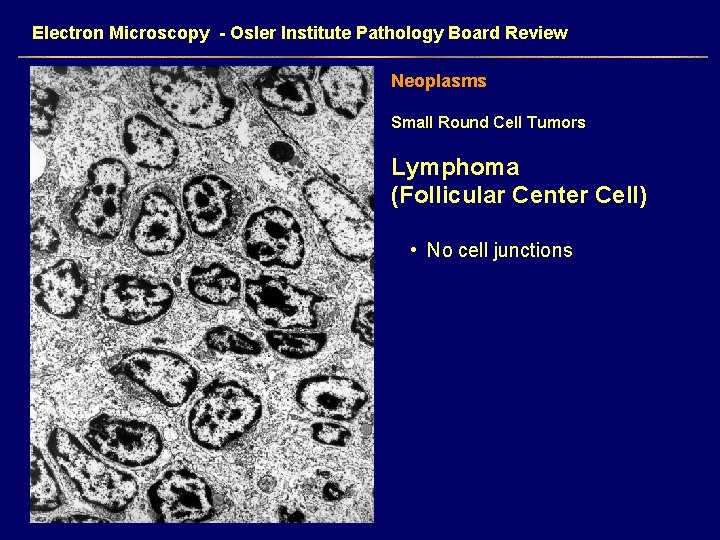 Electron Microscopy - Osler Institute Pathology Board Review Neoplasms Small Round Cell Tumors Lymphoma