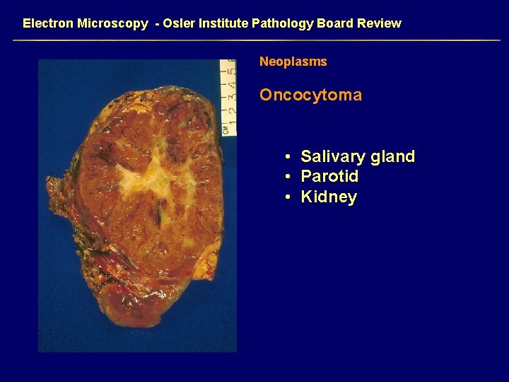Electron Microscopy - Osler Institute Pathology Board Review Neoplasms Oncocytoma • Salivary gland •