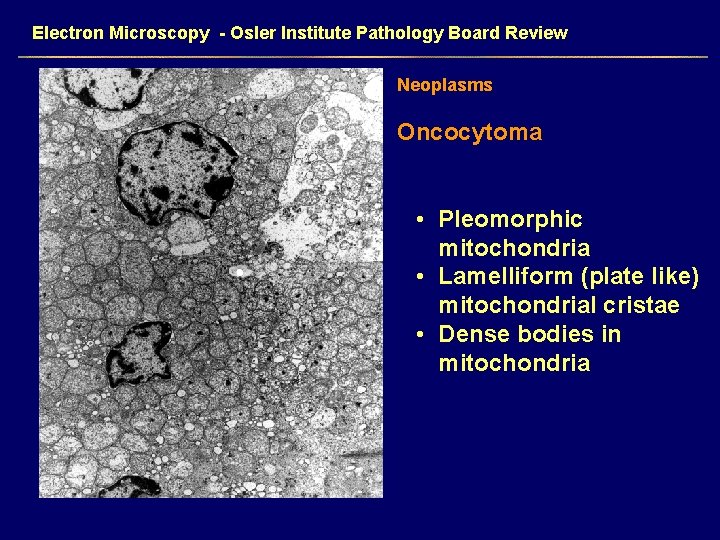 Electron Microscopy - Osler Institute Pathology Board Review Neoplasms Oncocytoma • Pleomorphic mitochondria •