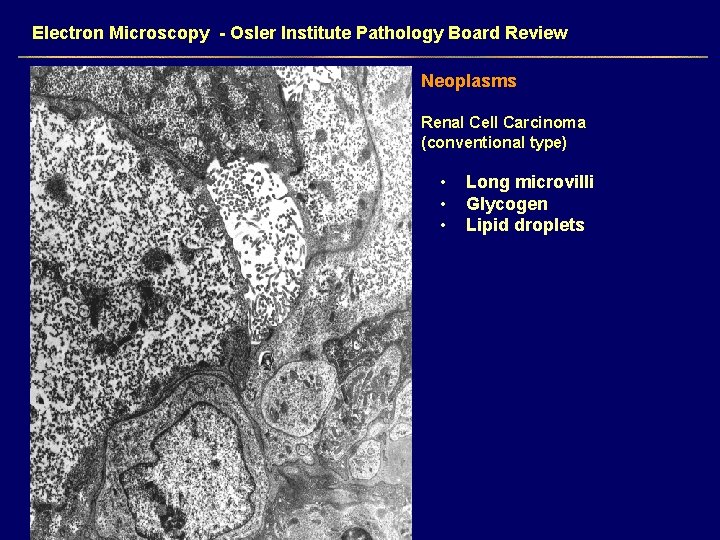 Electron Microscopy - Osler Institute Pathology Board Review Neoplasms Renal Cell Carcinoma (conventional type)