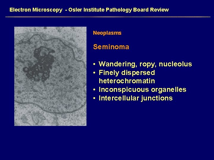 Electron Microscopy - Osler Institute Pathology Board Review Neoplasms Seminoma • Wandering, ropy, nucleolus