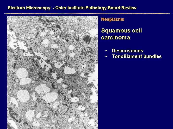 Electron Microscopy - Osler Institute Pathology Board Review Neoplasms Squamous cell carcinoma • Desmosomes