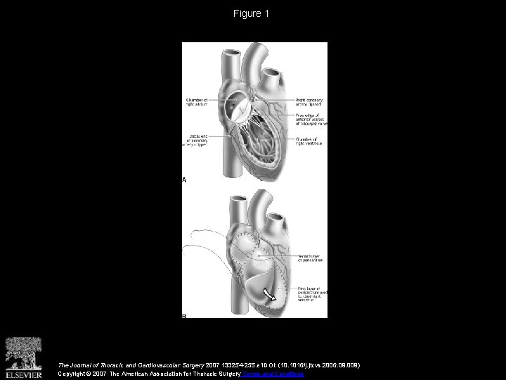 Figure 1 The Journal of Thoracic and Cardiovascular Surgery 2007 133254 -255. e 1