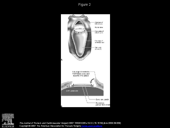 Figure 2 The Journal of Thoracic and Cardiovascular Surgery 2007 133254 -255. e 1