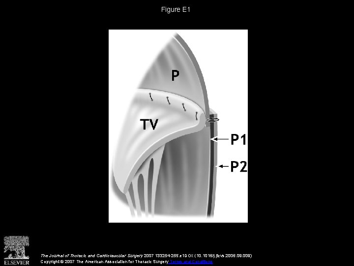 Figure E 1 The Journal of Thoracic and Cardiovascular Surgery 2007 133254 -255. e