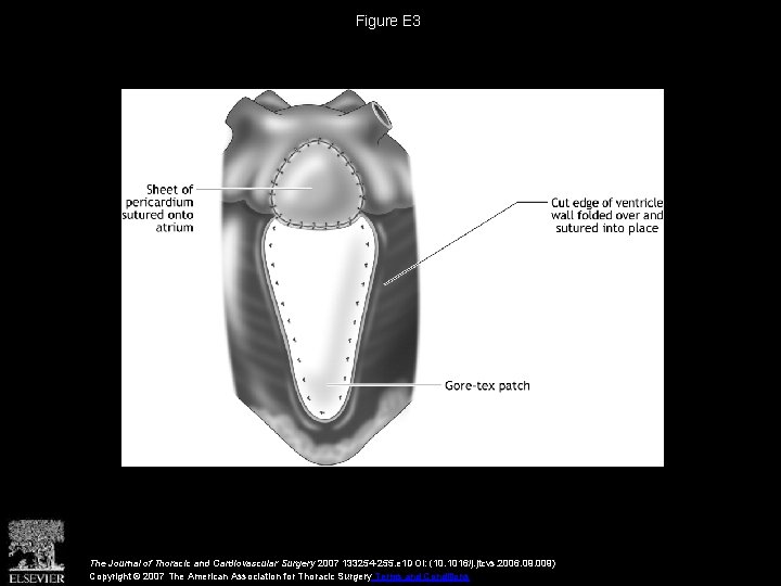 Figure E 3 The Journal of Thoracic and Cardiovascular Surgery 2007 133254 -255. e