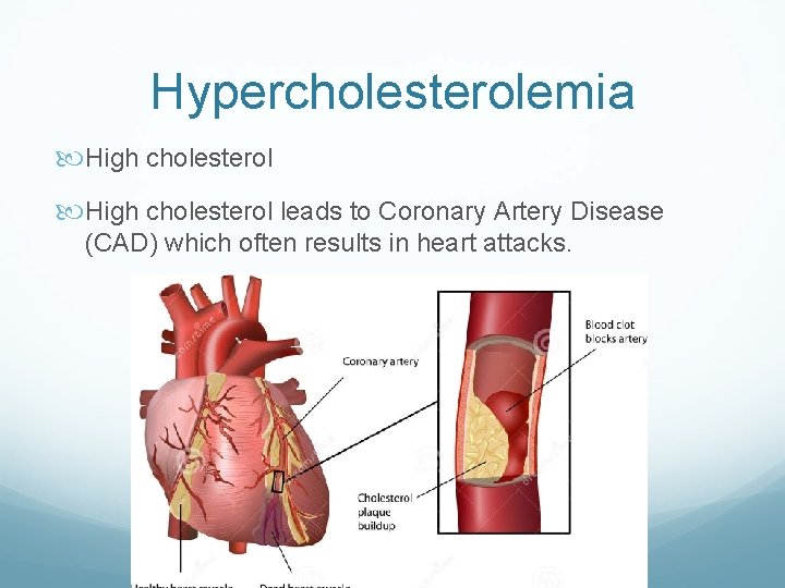 Hypercholesterolemia High cholesterol leads to Coronary Artery Disease (CAD) which often results in heart