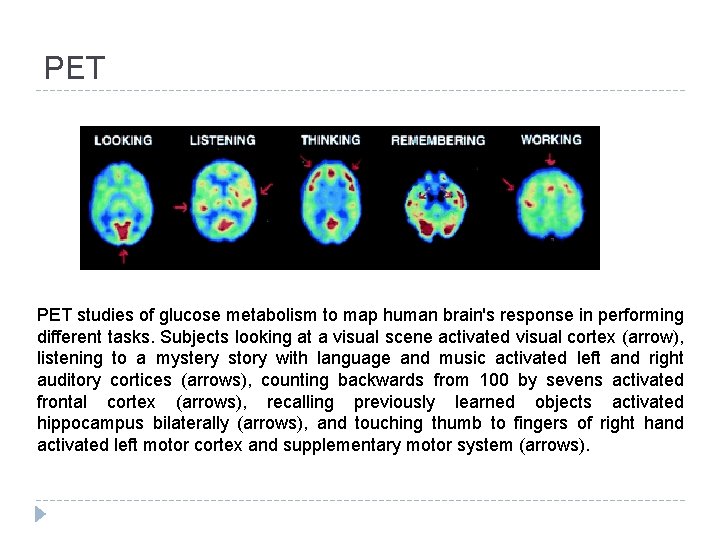 PET studies of glucose metabolism to map human brain's response in performing different tasks.