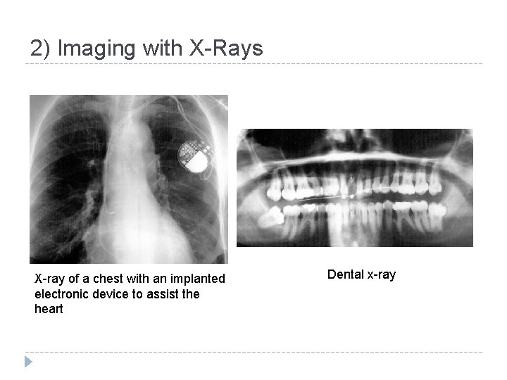 2) Imaging with X-Rays X-ray of a chest with an implanted electronic device to