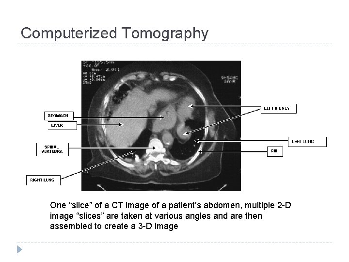 Computerized Tomography One “slice” of a CT image of a patient’s abdomen, multiple 2