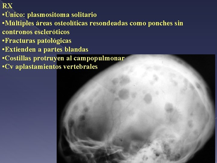 RX • Único: plasmositoma solitario • Múltiples áreas osteolíticas resondeadas como ponches sin contronos