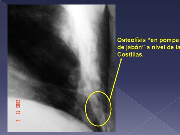 Osteolísis “en pompa de jabón” a nivel de la Costillas. 